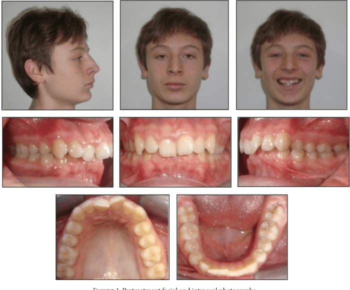 Class 2 malocclusion division 2