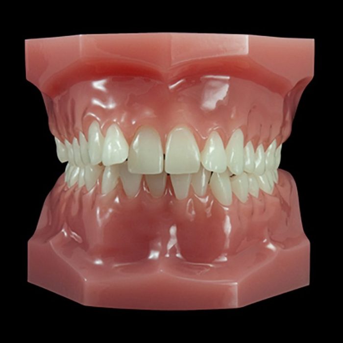 Class 2 malocclusion division 2