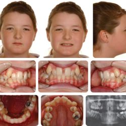 Class malocclusion division ii treatment plan pocketdentistry extraction