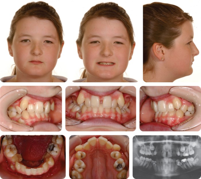 Class malocclusion division ii treatment plan pocketdentistry extraction