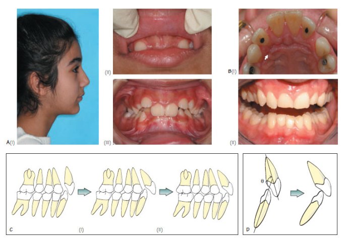 Class ii division malocclusion before after headgear prevalence use term pocketdentistry